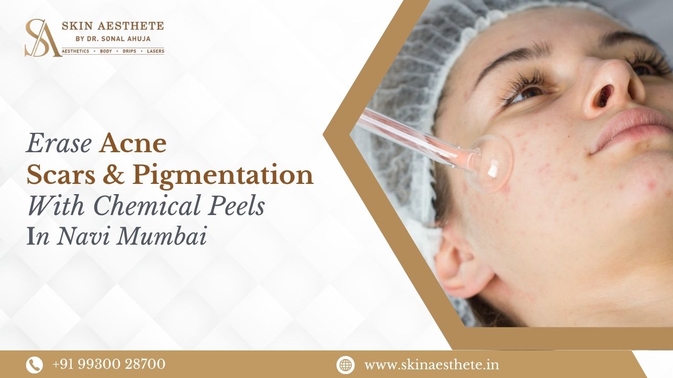 Erase Acne Scars & Pigmentation with Chemical Peels in Navi Mumbai 