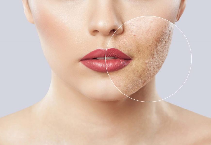 Acne Scar Treatment in Navi Mumbai