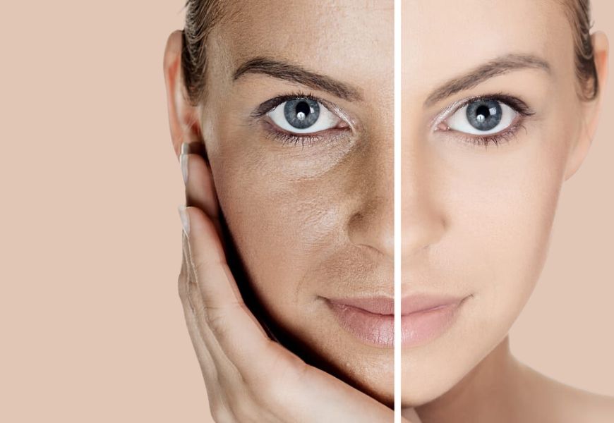 Facial Pigmentation Treatment Doctors in Belapur, Navi Mumbai