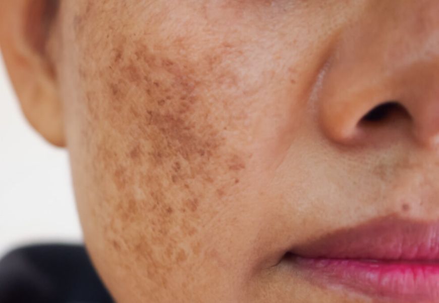 Melasma treatment in Belapur, Navi Mumbai