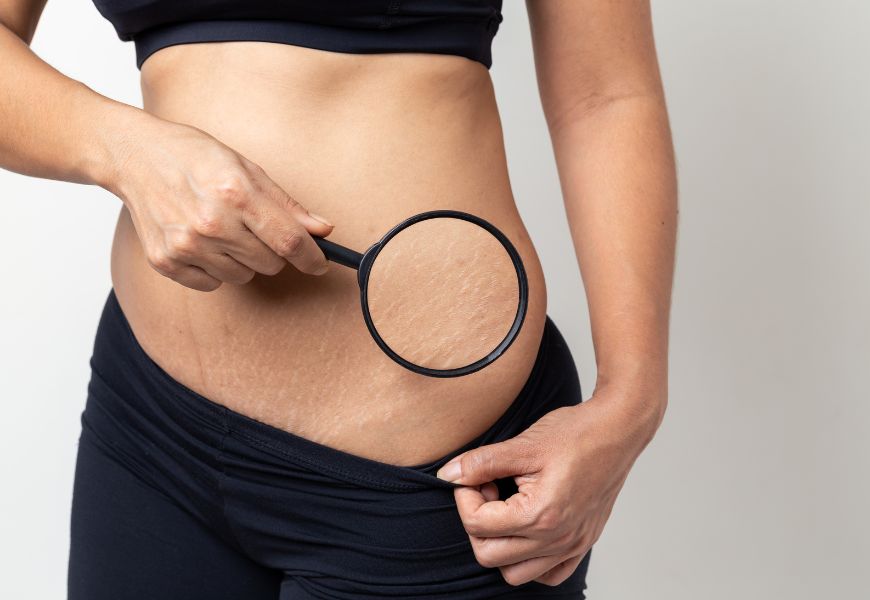 Stretch Mark Treatment in Navi Mumbai